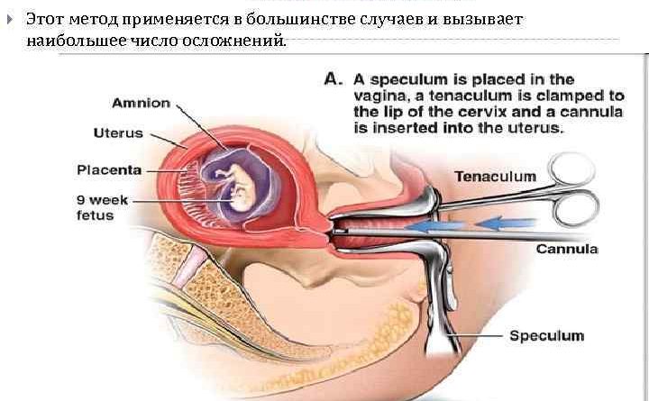 Ноль — Аборт
